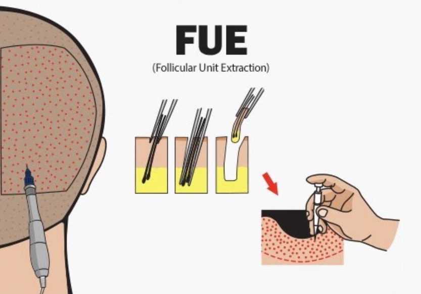 maxwell fue hair transplant korea