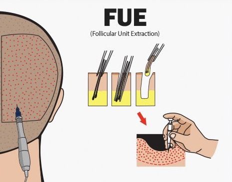 fue maxwell hair transplant