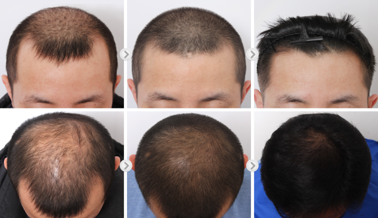 hair transplant korea hair loss stages