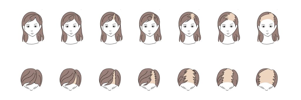female pattern hair loss korea