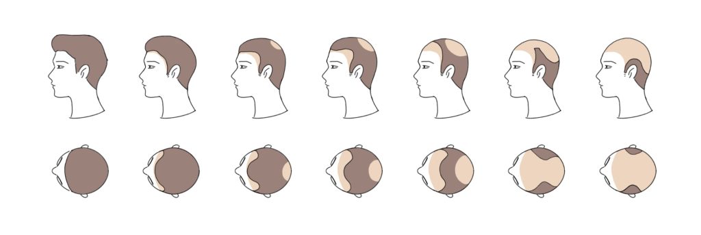 male pattern hair loss korea