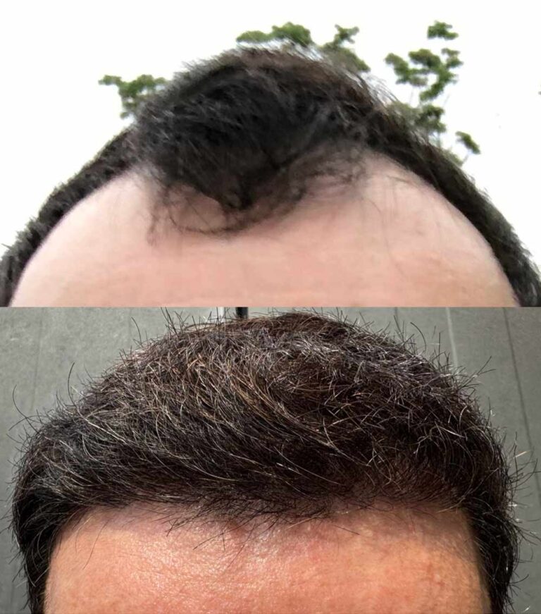 From Balding to Thriving With a Hair Transplant in Korea