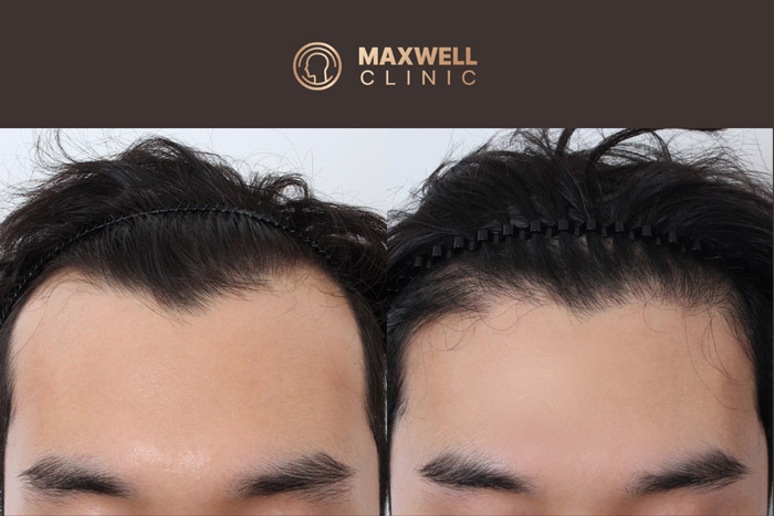 Hair Transplant in Your 20s, 30s, or 40s: Is It the Right Time?