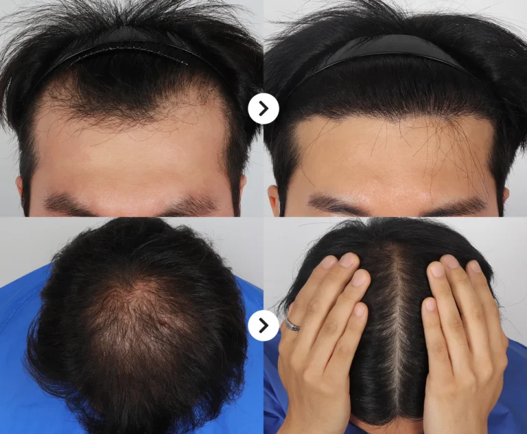 Early-Onset Hair Loss in Your 20s–40s: Hidden Causes, Diagnosis & Effective Treatments in Korea