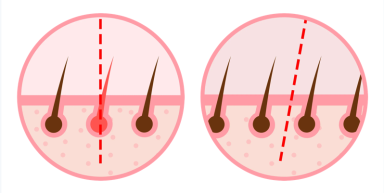 The Key to Successful Hair Transplantation: Graft Survival Rate ⎯ Maxwell’s 5 Scientific Keys
