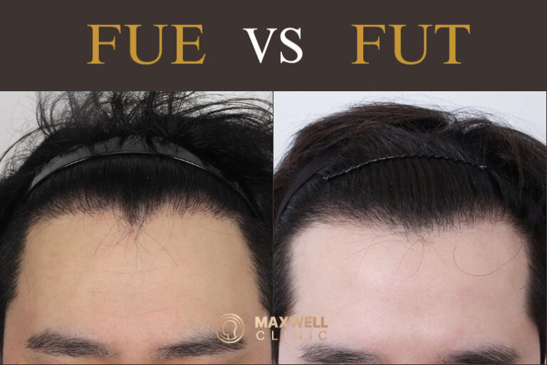 3000-Graft Hair Transplant: FUT vs FUE Reviews and How to Choose the Best Method